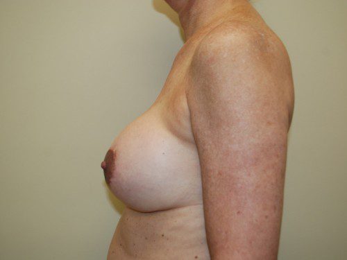 Breast Revision Before Patient 5