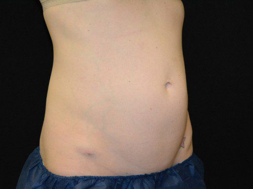 Coolsculpting Before Patient 3