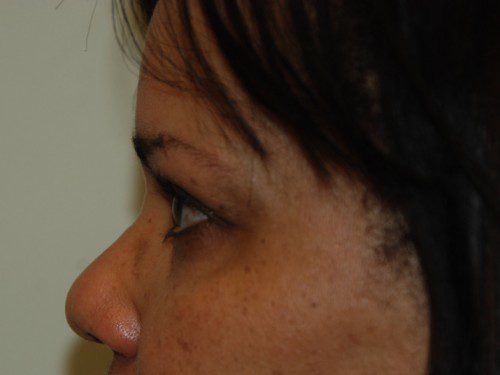 Eyelid Surgery Before Patient 5