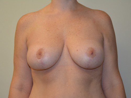 Breast Lift After Patient 1