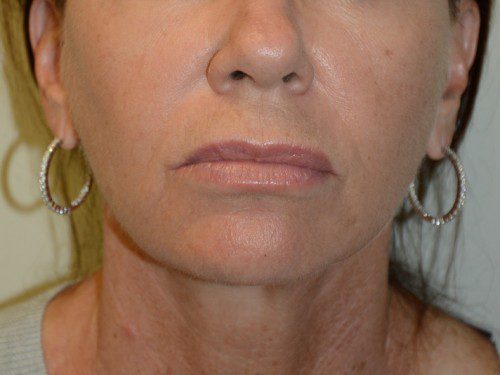 Facelift After Patient 1