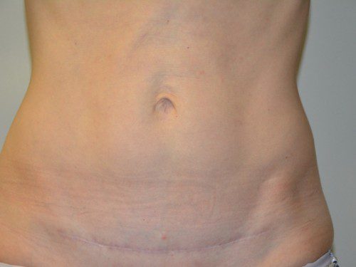 Mini Tummy Tuck After Patient 1