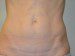 Mini Tummy Tuck After Patient Thumbnail 1