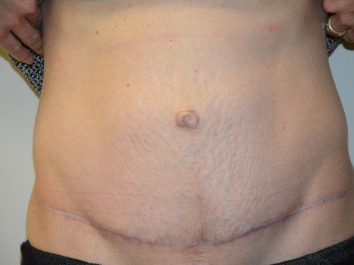 Tummy Tuck After Patient 1