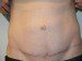 Tummy Tuck After Patient Thumbnail 1