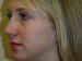 Rhinoplasty After Patient Thumbnail 2