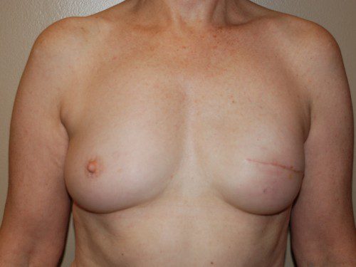 Breast Reconstruction Immediate Implant After Patient 1