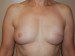 Breast Reconstruction Immediate Implant After Patient Thumbnail 1
