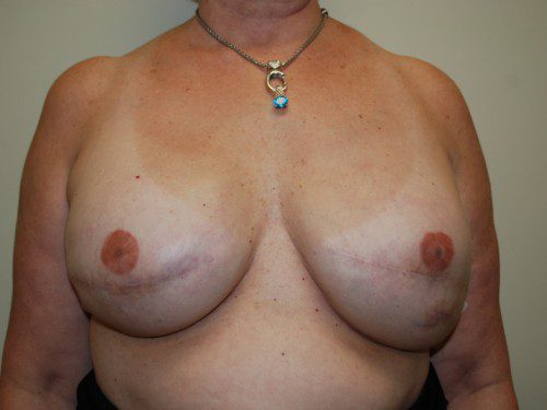 Breast Reconstruction Tissue Expanders After Patient 1