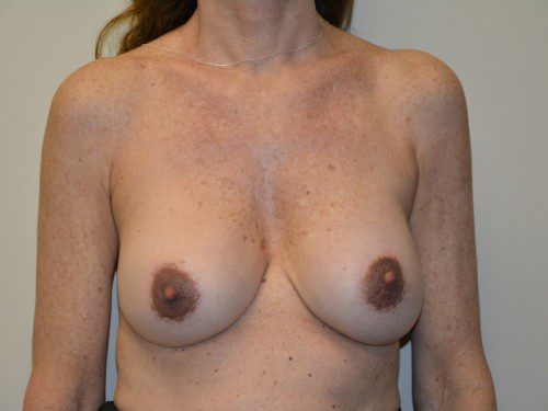 Breast Revision After Patient 1