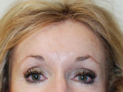 Brow Lift After Patient 1