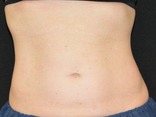 Coolsculpting After Patient 1