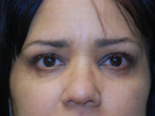 Eyelid Surgery After Patient 1