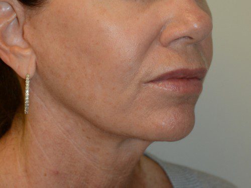 Facelift After Patient 2