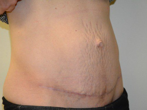 Tummy Tuck After Patient 2