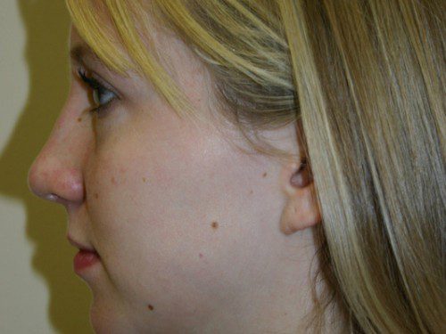 Rhinoplasty After Patient 3