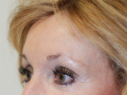 Brow Lift After Patient 2