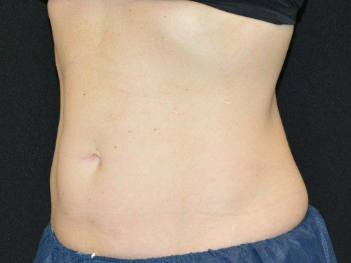 Coolsculpting After Patient 2