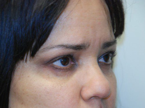 Eyelid Surgery After Patient 2