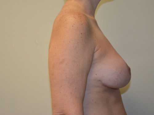 Breast Lift After Patient 4