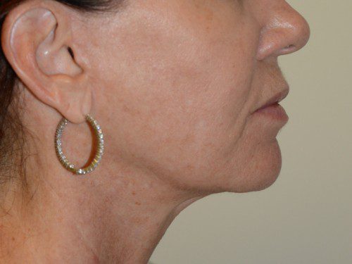 Facelift After Patient 4