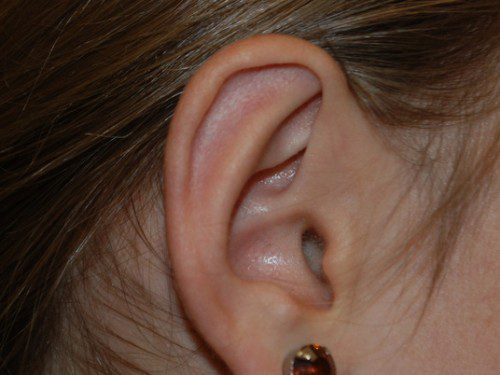 Prominent Ear Surgery After Patient 3