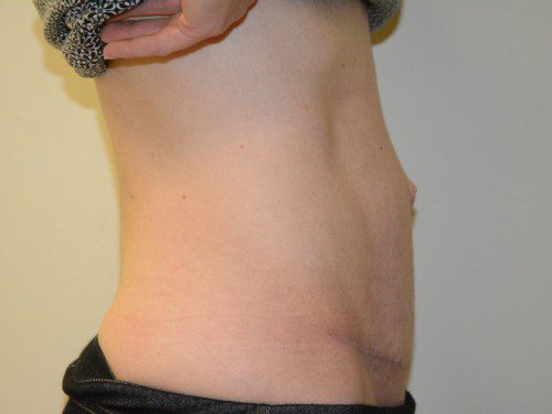 Tummy Tuck After Patient 4