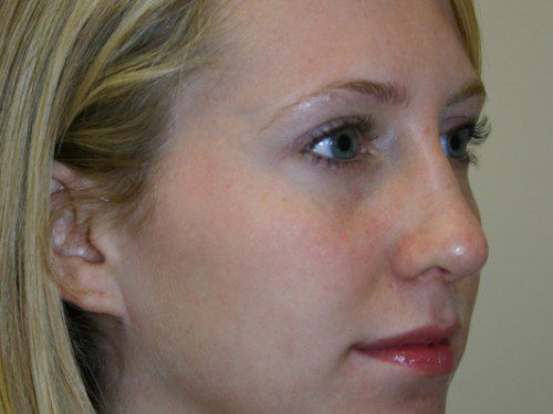 Rhinoplasty After Patient 4