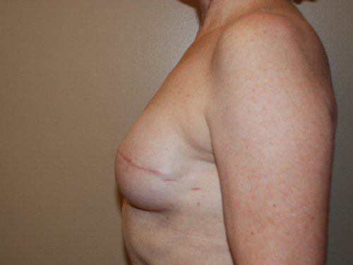 Breast Reconstruction Immediate Implant After Patient 5