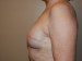 Breast Reconstruction Immediate Implant After Patient Thumbnail 5