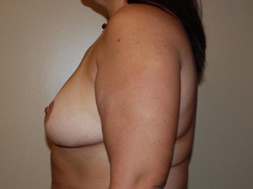 Breast Reduction After Patient 4