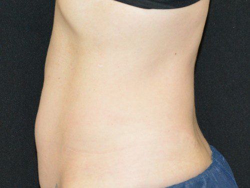 Coolsculpting After Patient 4