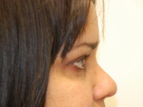 Eyelid Surgery After Patient 4