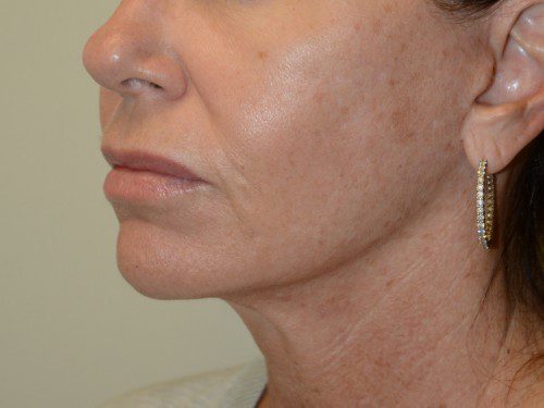 Facelift After Patient 3