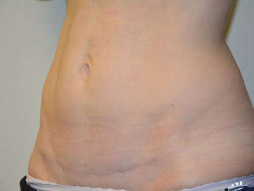 Mini Tummy Tuck After Patient 3