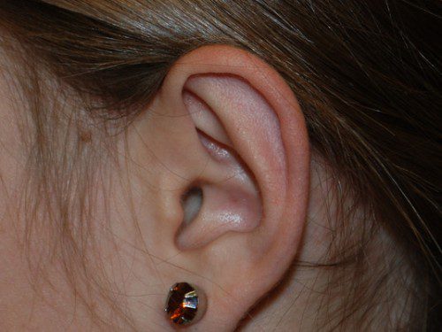 Prominent Ear Surgery After Patient 4