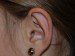 Prominent Ear Surgery After Patient Thumbnail 4