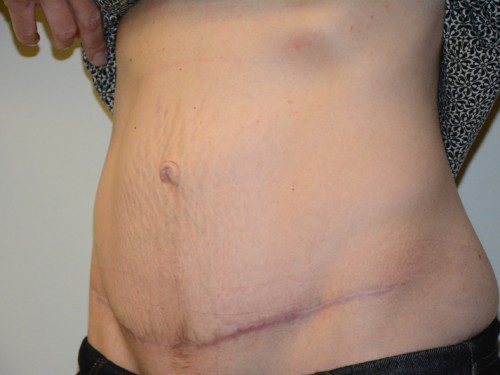 Tummy Tuck After Patient 3