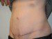 Tummy Tuck After Patient Thumbnail 3