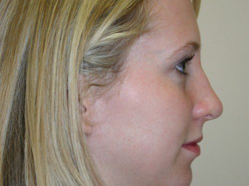 Rhinoplasty After Patient 5