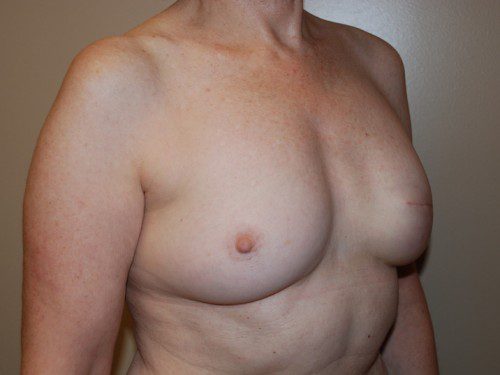 Breast Reconstruction Immediate Implant After Patient 2