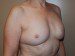 Breast Reconstruction Immediate Implant After Patient Thumbnail 2