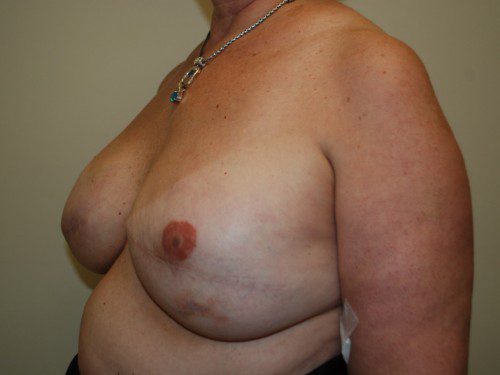 Breast Reconstruction Tissue Expanders After Patient 3