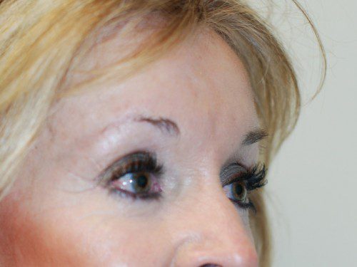 Brow Lift After Patient 3