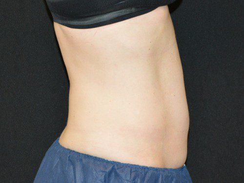 Coolsculpting After Patient 5