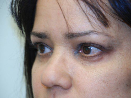 Eyelid Surgery After Patient 3