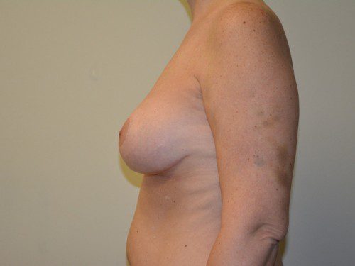 Breast Lift After Patient 5