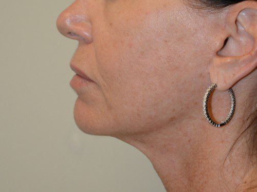 Facelift After Patient 5