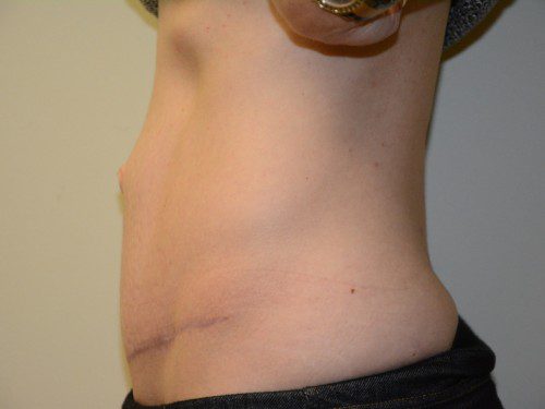 Tummy Tuck After Patient 5