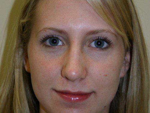 Rhinoplasty After Patient 1